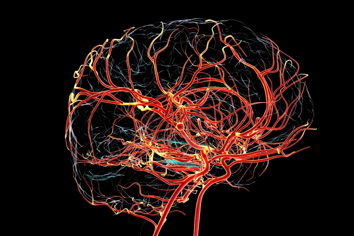 Ilustração de um aneurisma sacular (em forma de baga) na artéria cerebral média, destacando a patologia vascular e o risco de acidente vascular cerebral. Metrópoles