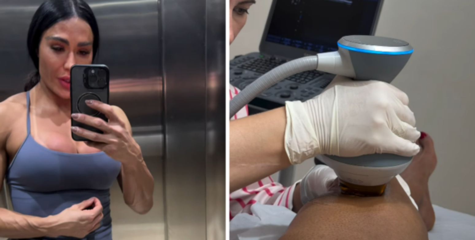 Gracyanne Barbosa faz pun&ccedil;&atilde;o para retirar l&iacute;quido do joelho