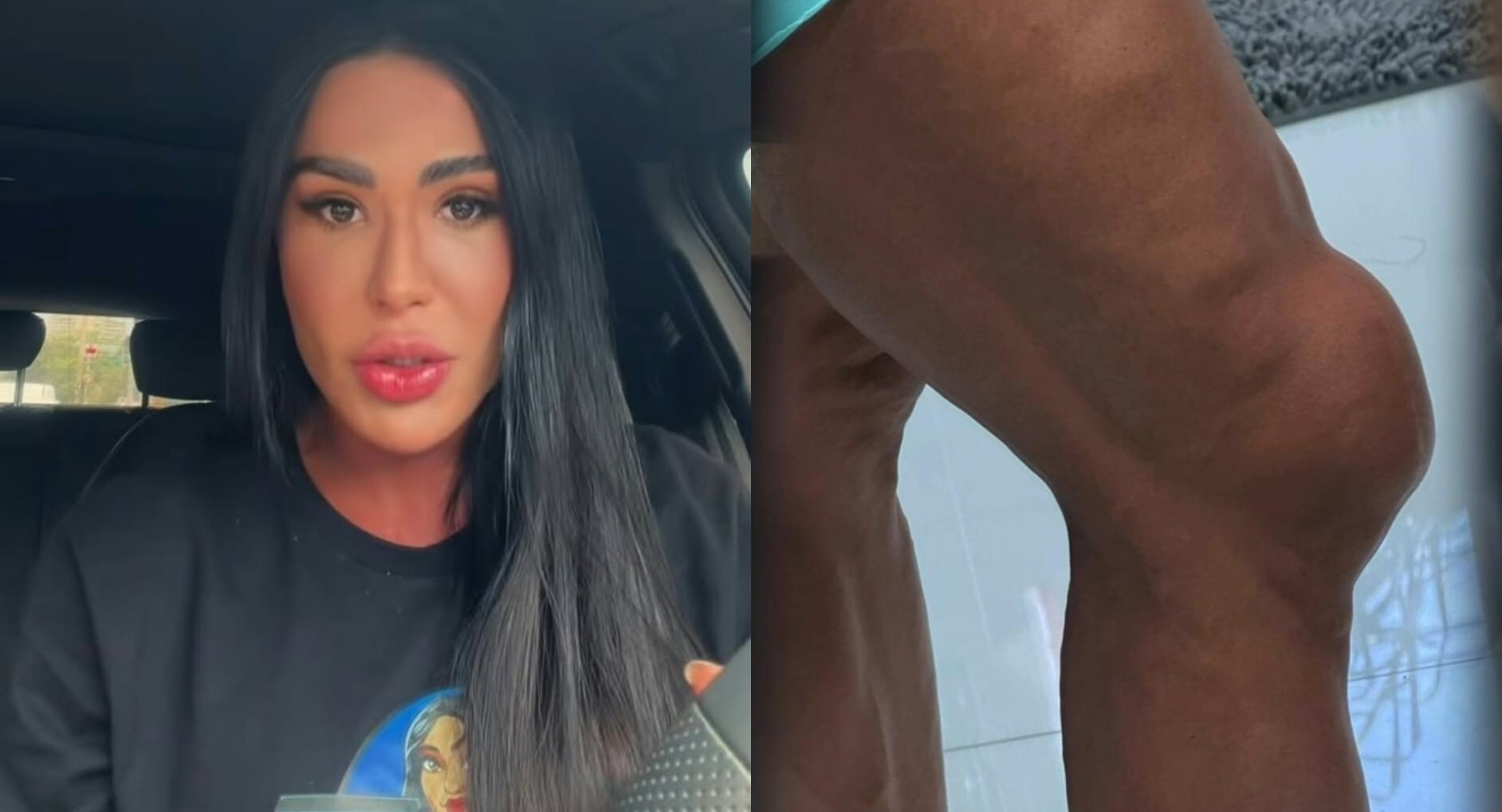 Gracyanne Barbosa explica motivo de joelho inchado que deixou fãs assustados